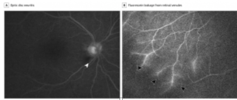 Case report links COVID-19 with permanent vision loss