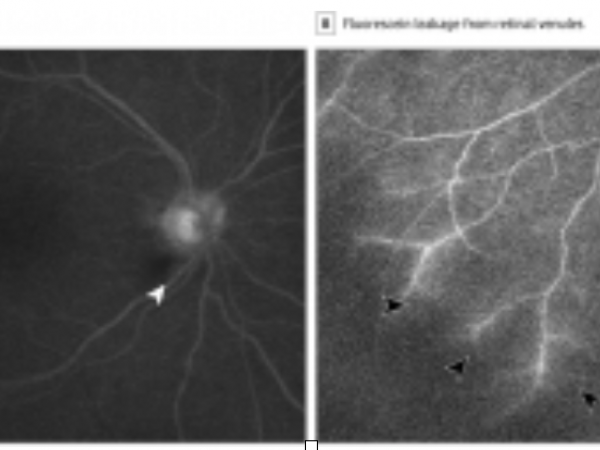 Case report links COVID-19 with permanent vision loss  