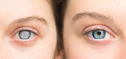 Ireland’s eye-care waiting lists increase during COVID-19