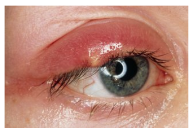 External Eye & Adnexa Triage & Management